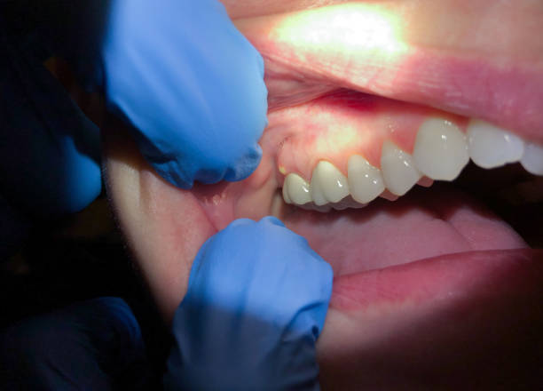 Best Cracked Tooth Emergency Dentist  in La Ada Flintridge, CA